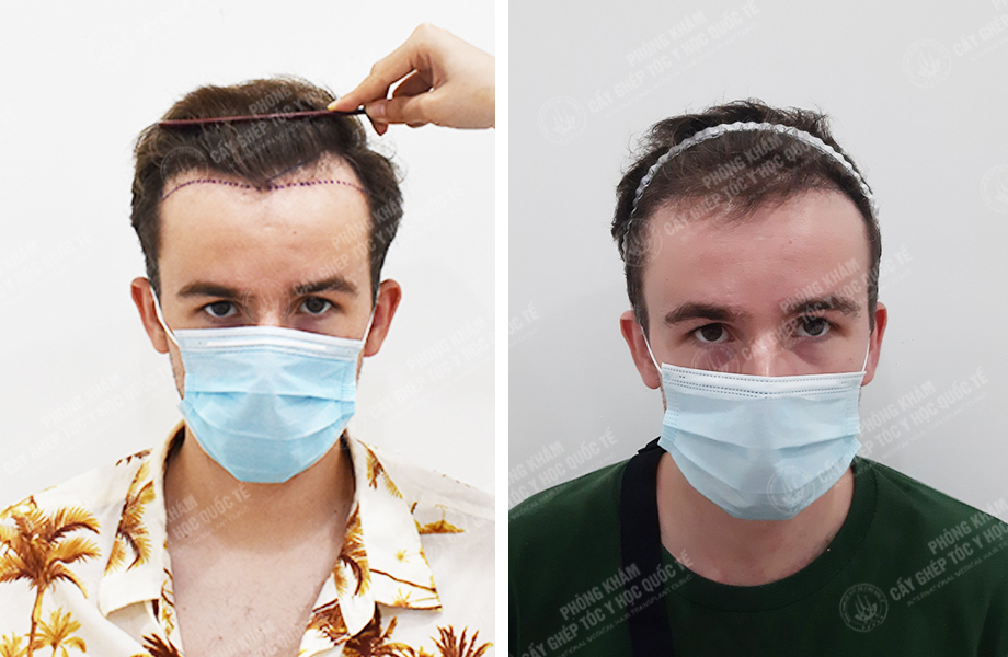  Leo Parry - Cấy tóc đường chữ M 1