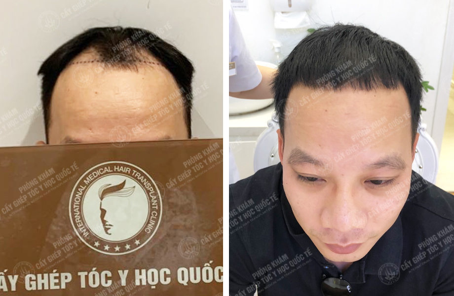  Hoàng Thái Sơn - Cấy tóc tự thân 1