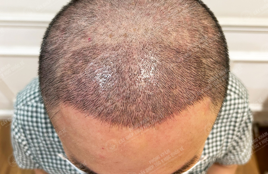 Bùi Văn Lanh - Cấy tóc đường chữ M 4