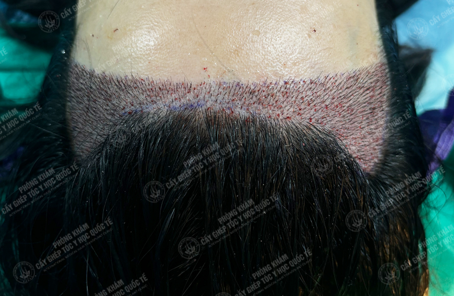 Đỗ Thị Hạnh - Cấy tóc đường chữ M 4