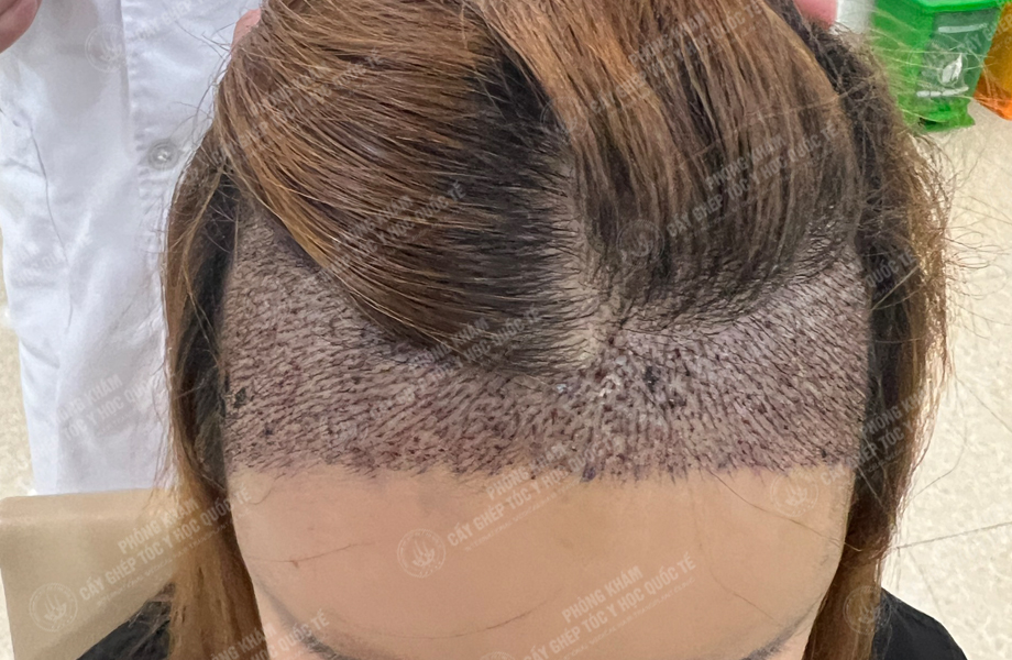 Ngô Thị Hồng - Cấy tóc đường chữ M 4