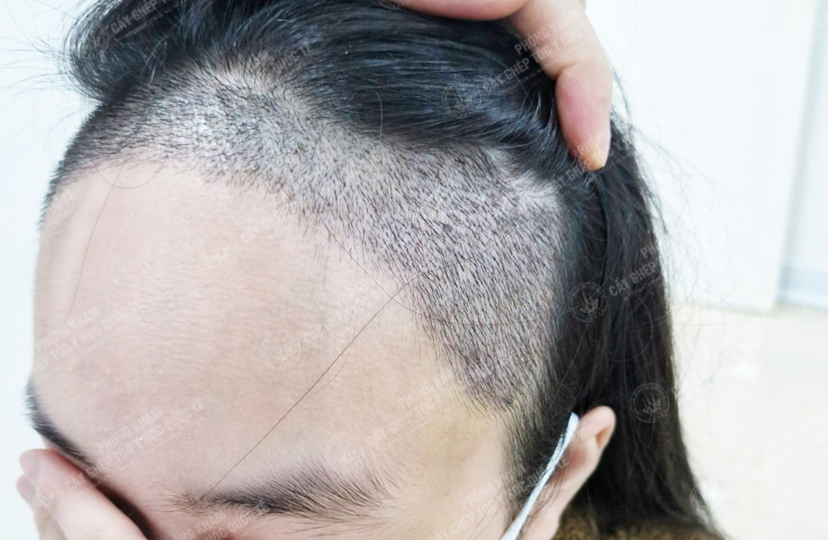 Nguyễn Thị Thơ - Cấy tóc đường chữ M 4