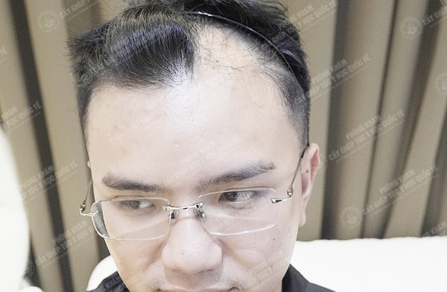 Nguyễn Quốc Hưng - Cấy tóc đường chữ M 4