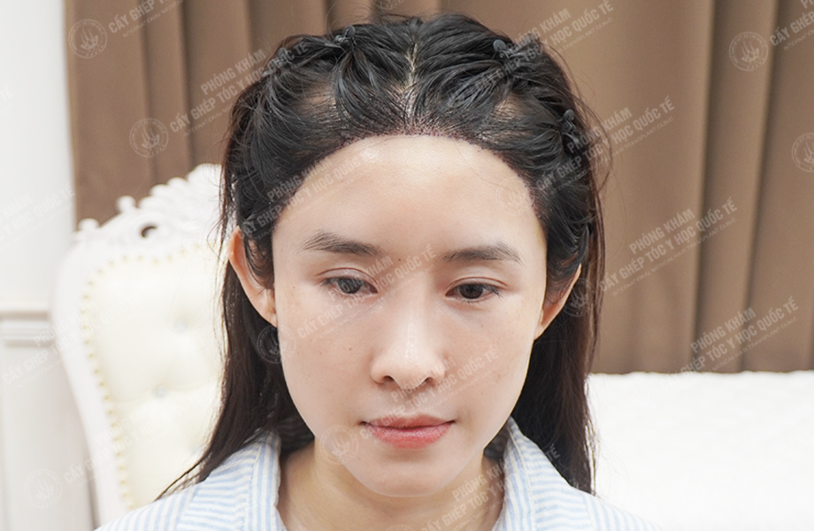 Nguyễn Ngọc Ngà - Cấy tóc tự thân 4