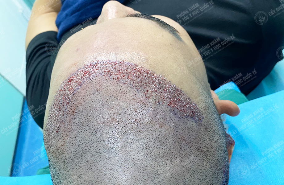 Đỗ Văn  Nhân - Cấy tóc đường chữ M 4