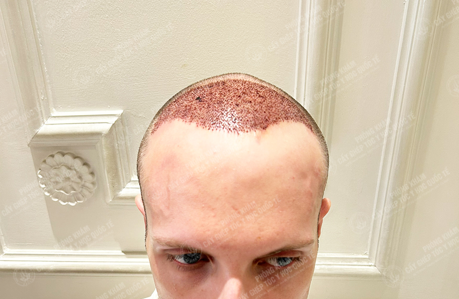 SONNY - Cấy tóc đường chữ M 4