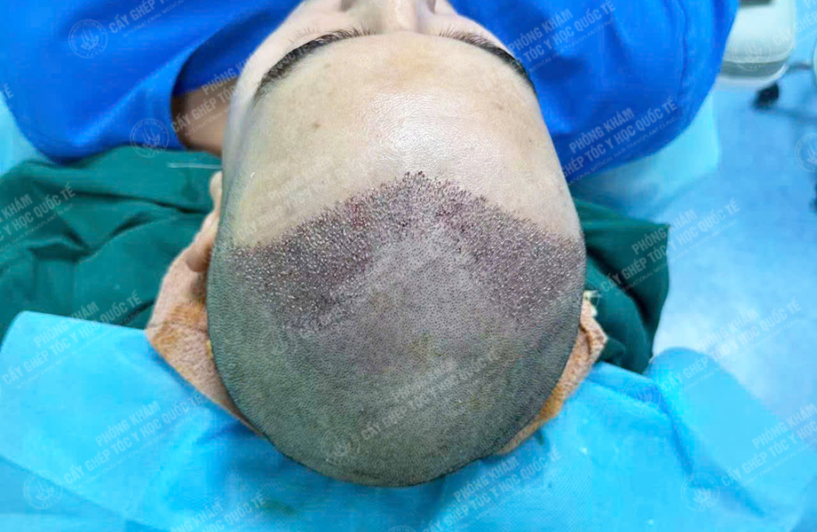 Nguyễn Nhật Hoàng - Cấy tóc đường chữ M 4