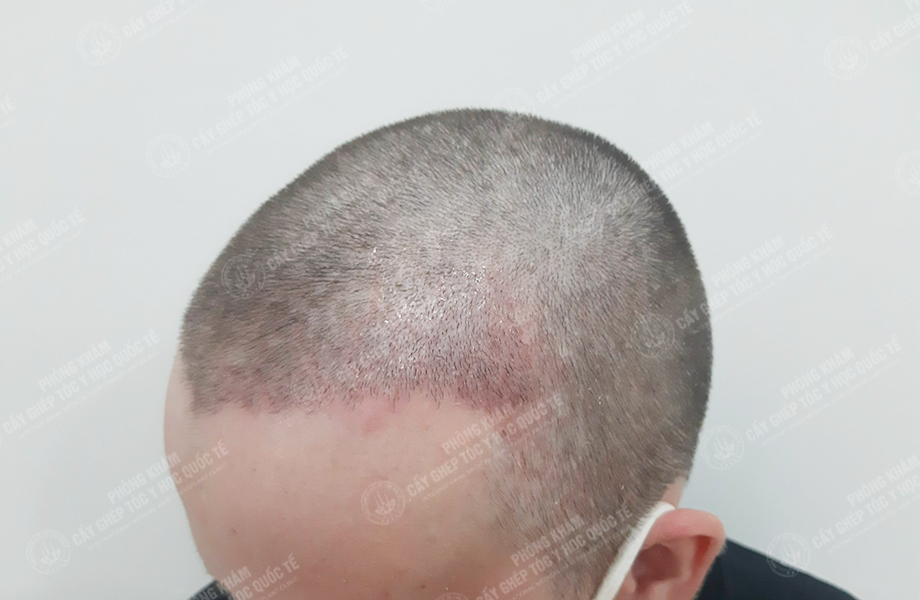 Leo Parry - Cấy tóc đường chữ M 4