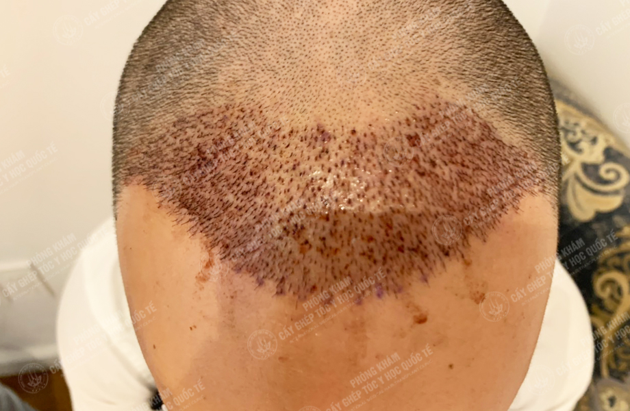 Hoàng Thái Sơn - Cấy tóc đường chữ M 4