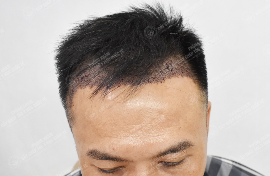 Đào Văn Minh - Cấy tóc đường chữ M 4