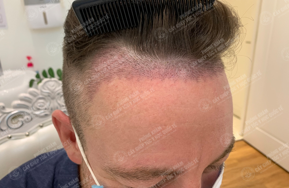 JAME SON - Cấy tóc đường chữ M 4