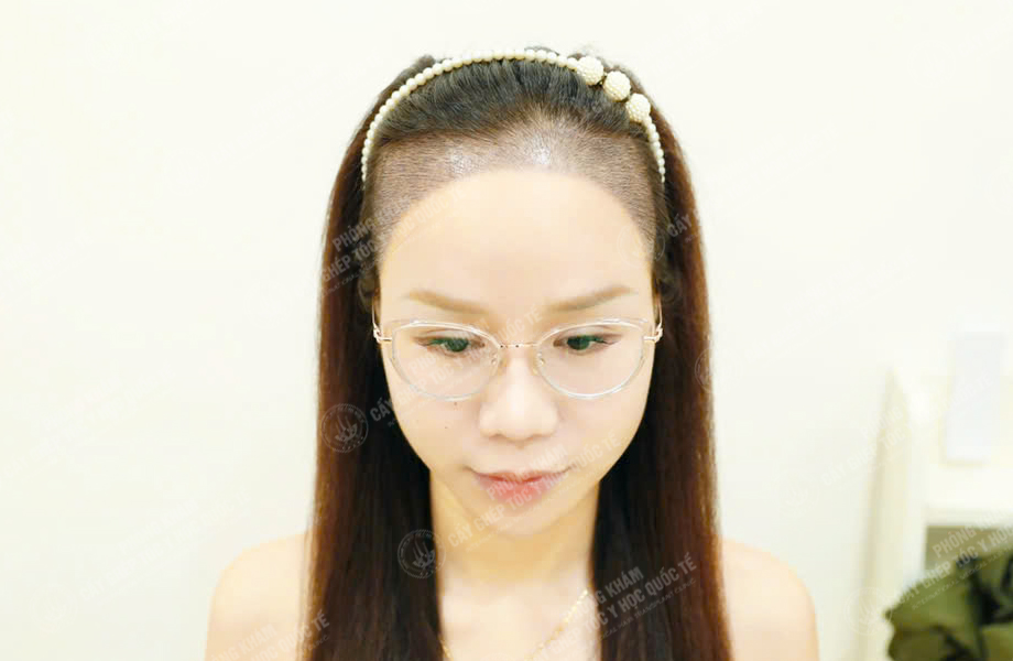 Nguyễn Minh Trang - Cấy tóc đường chữ M 4