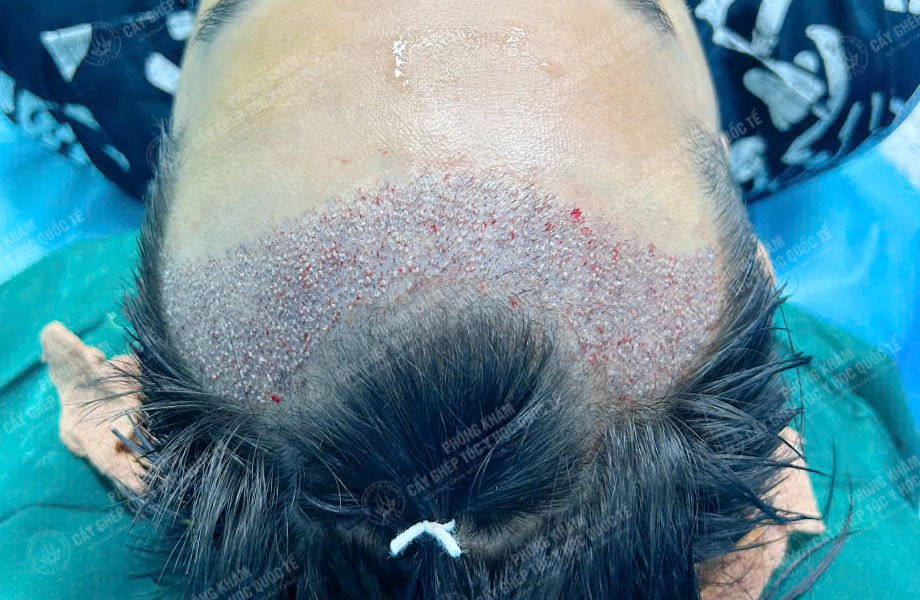 Nguyễn Minh Quân - Cấy tóc đường chữ M 4