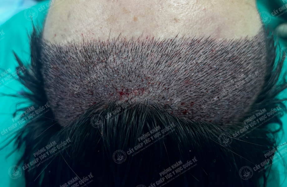 Nguyễn Hoàng Hưng - Cấy tóc đường chữ M 4