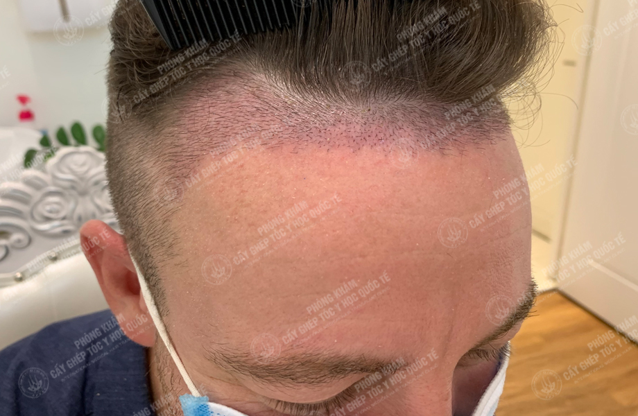 Jay Son - Cấy tóc đường chữ M 4