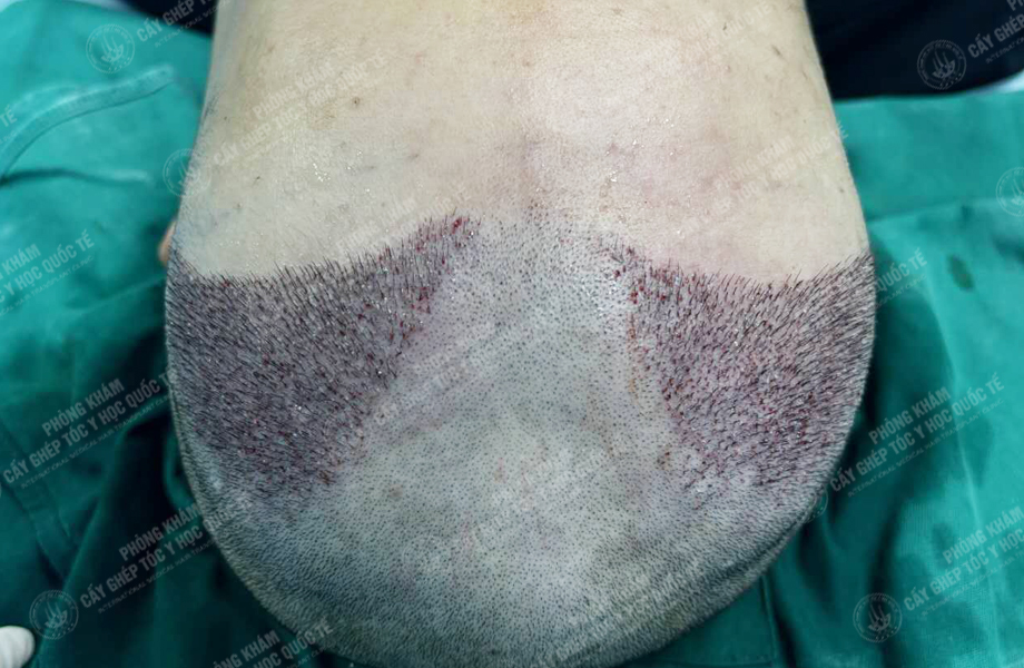 Đỗ Thanh Nhân - Cấy tóc đường chữ M 4