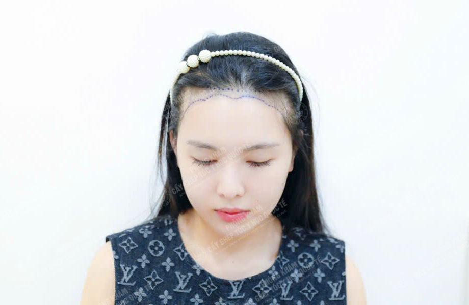 Đào Thị Phương - Cấy tóc đường chữ M 4