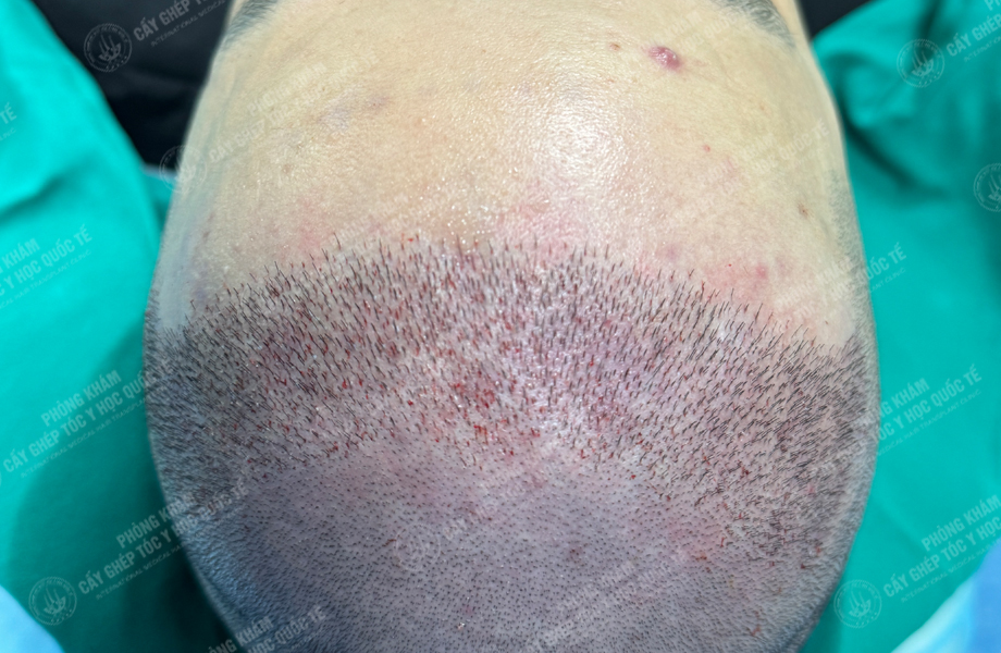 Lê Thanh Ngọc - Cấy tóc đường chữ M 4