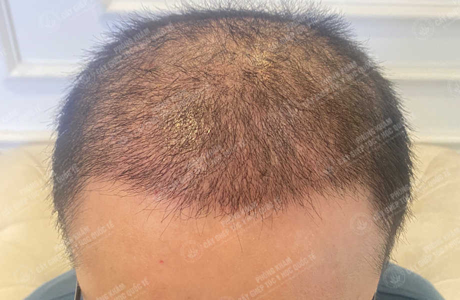 Bùi Văn Lanh - Cấy tóc đường chữ M 5