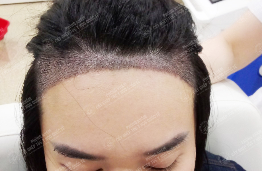 Đỗ Thị Hạnh - Cấy tóc đường chữ M 5