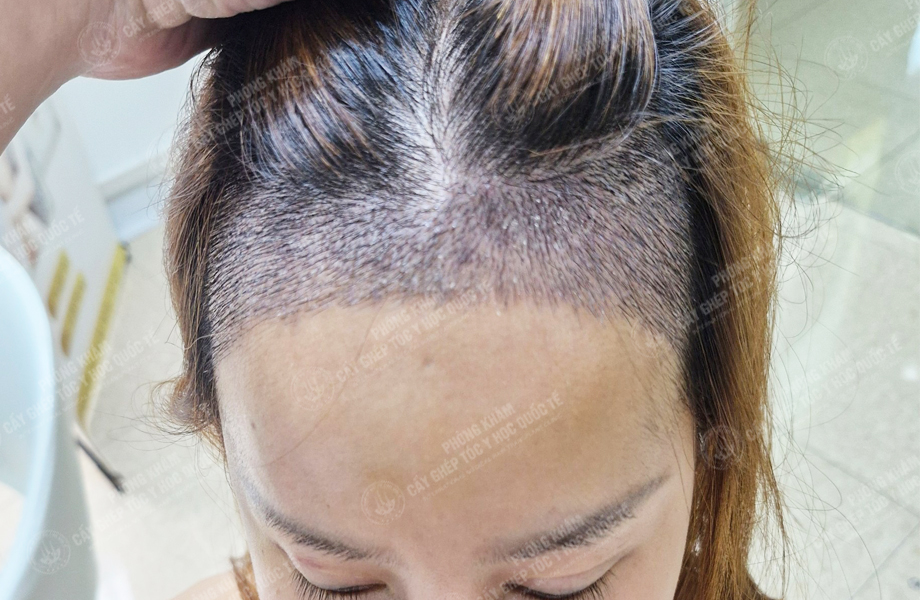 Ngô Thị Hồng - Cấy tóc đường chữ M 5