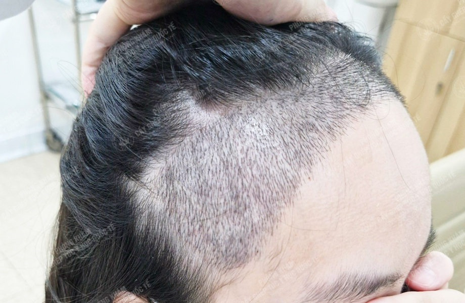 Nguyễn Thị Thơ - Cấy tóc đường chữ M 5