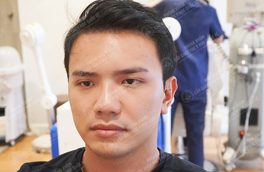 Nguyễn Quốc Hưng - Cấy tóc đường chữ M 5