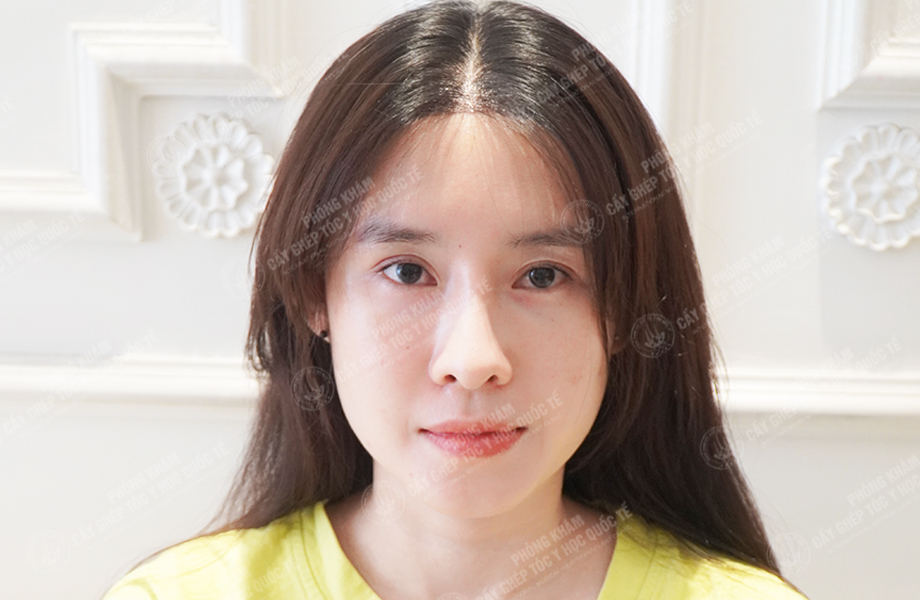 Nguyễn Ngọc Ngà - Cấy tóc tự thân 5