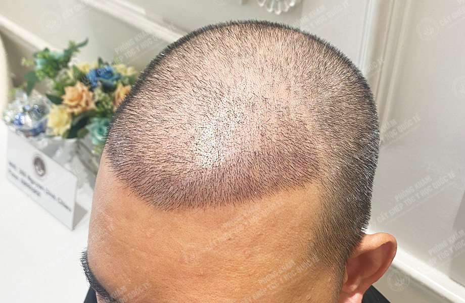 Đỗ Văn  Nhân - Cấy tóc đường chữ M 5