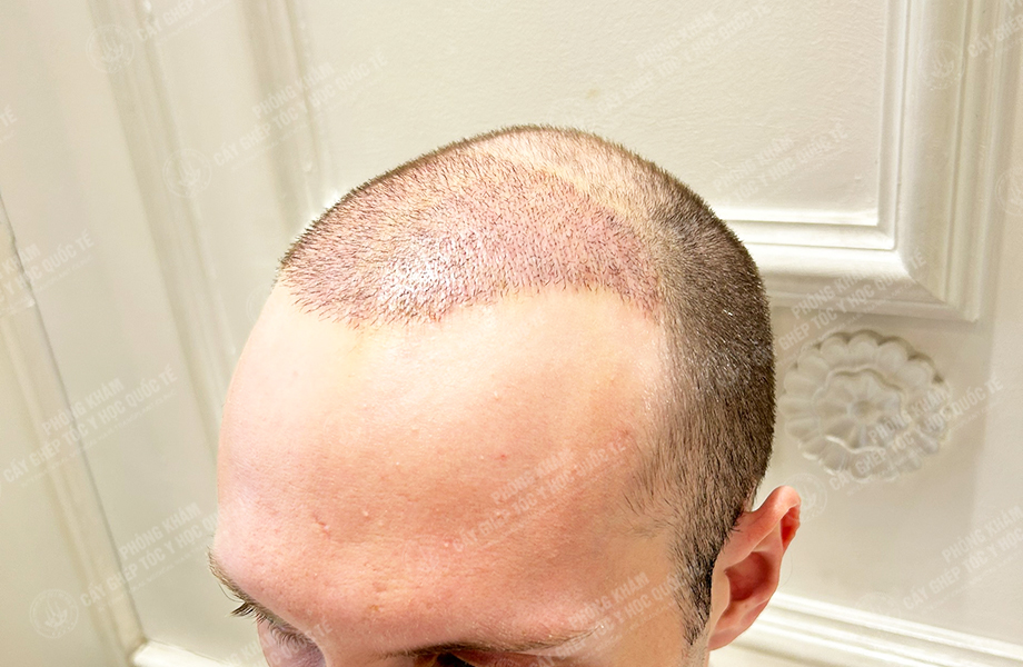 SONNY - Cấy tóc đường chữ M 5