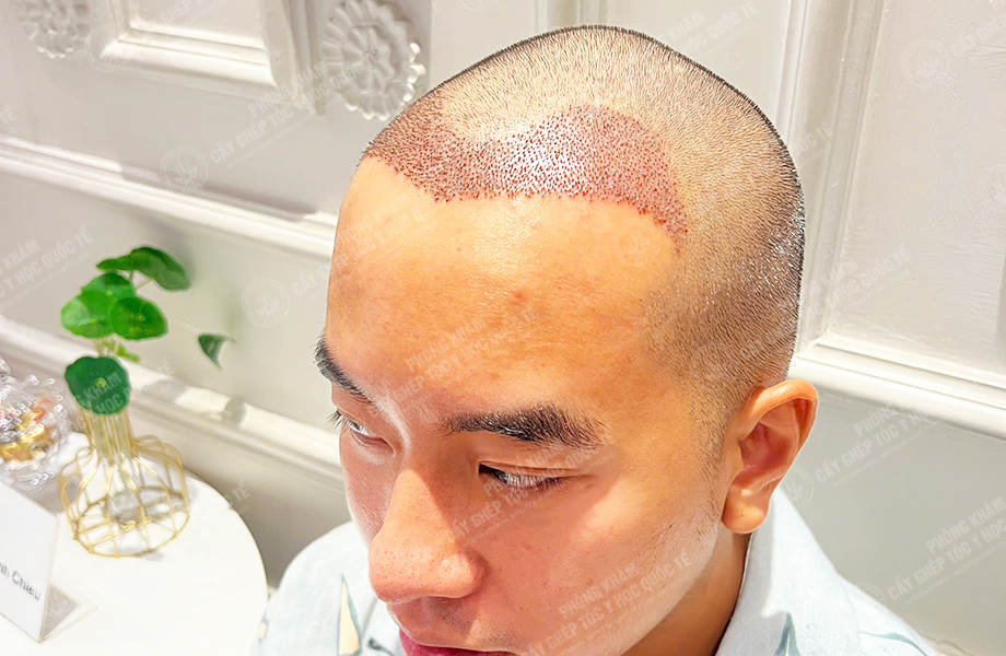 Nguyễn Nhật Hoàng - Cấy tóc đường chữ M 5