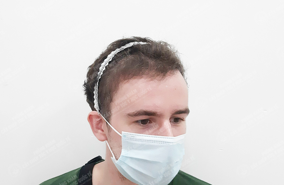 Leo Parry - Cấy tóc đường chữ M 5