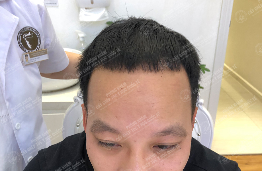 Hoàng Thái Sơn - Cấy tóc đường chữ M 5