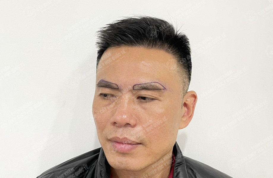 Đào Văn Minh - Cấy tóc đường chữ M 5