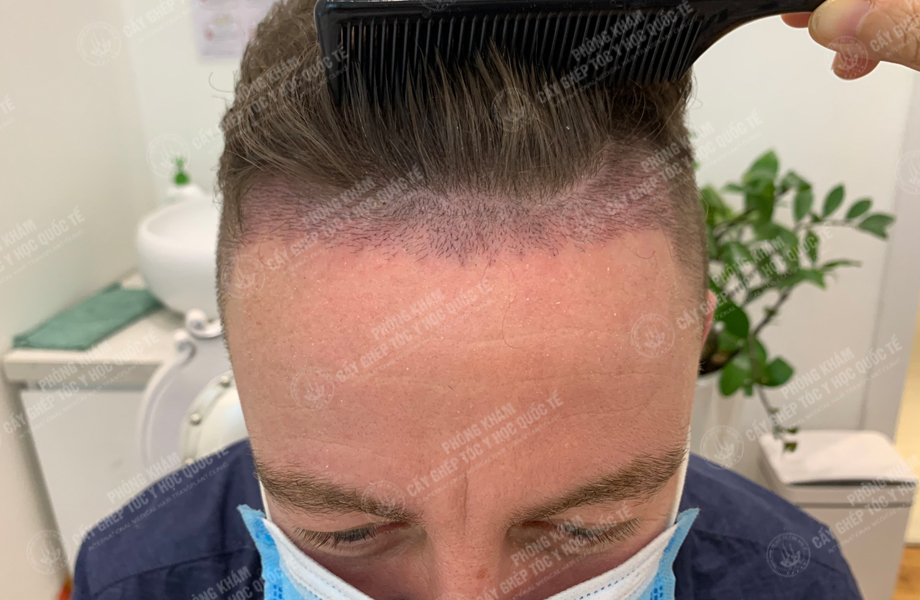 JAME SON - Cấy tóc đường chữ M 5