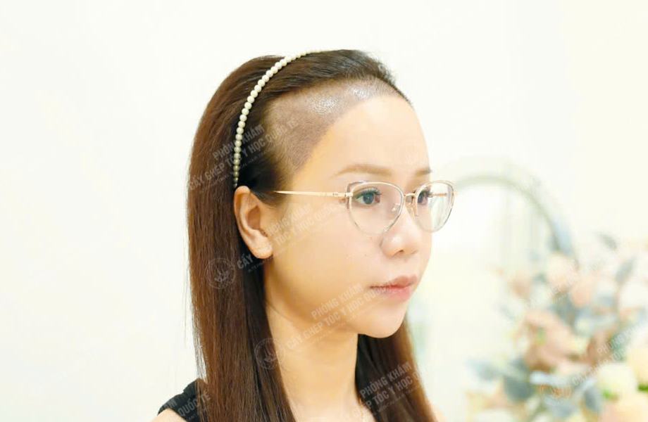 Nguyễn Minh Trang - Cấy tóc đường chữ M 5