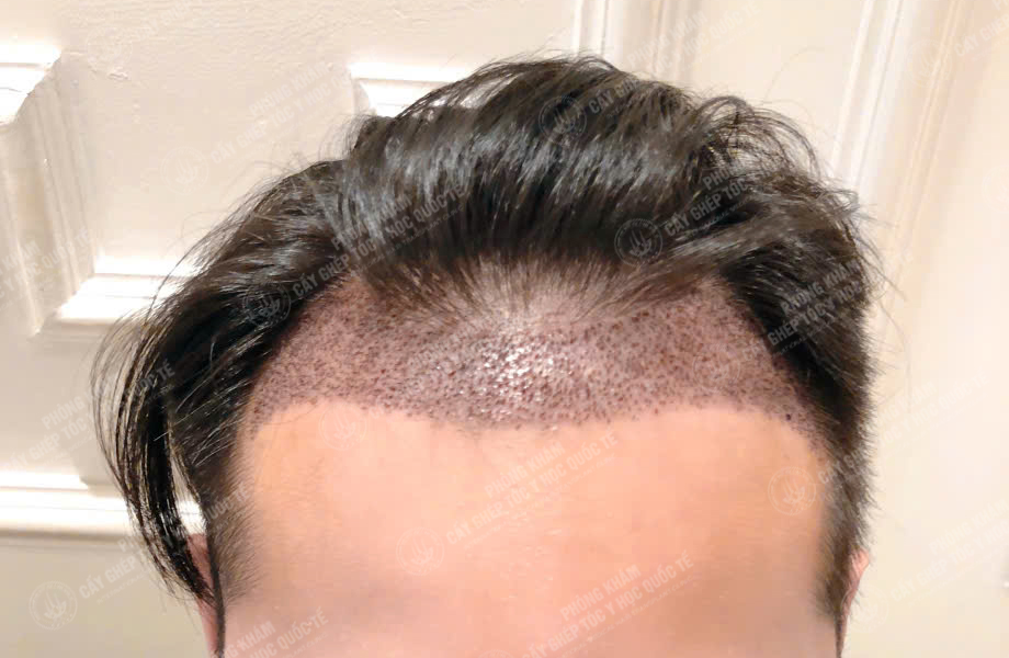 Nguyễn Minh Quân - Cấy tóc đường chữ M 5