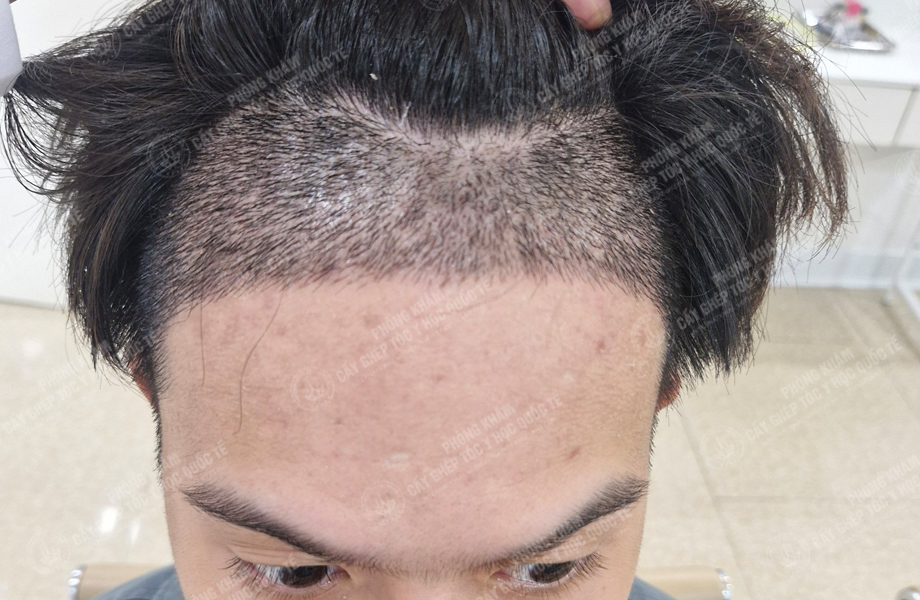 Nguyễn Hoàng Hưng - Cấy tóc đường chữ M 5