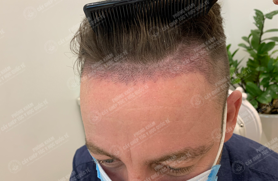 Jay Son - Cấy tóc đường chữ M 5