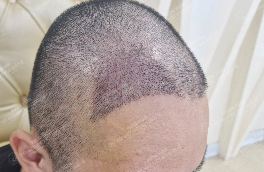 Đỗ Thanh Nhân - Cấy tóc đường chữ M 5