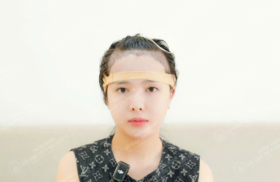 Đào Thị Phương - Cấy tóc đường chữ M 5