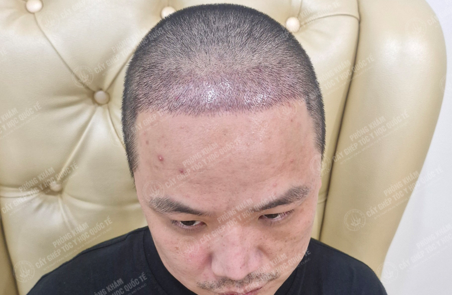 Lê Thanh Ngọc - Cấy tóc đường chữ M 5