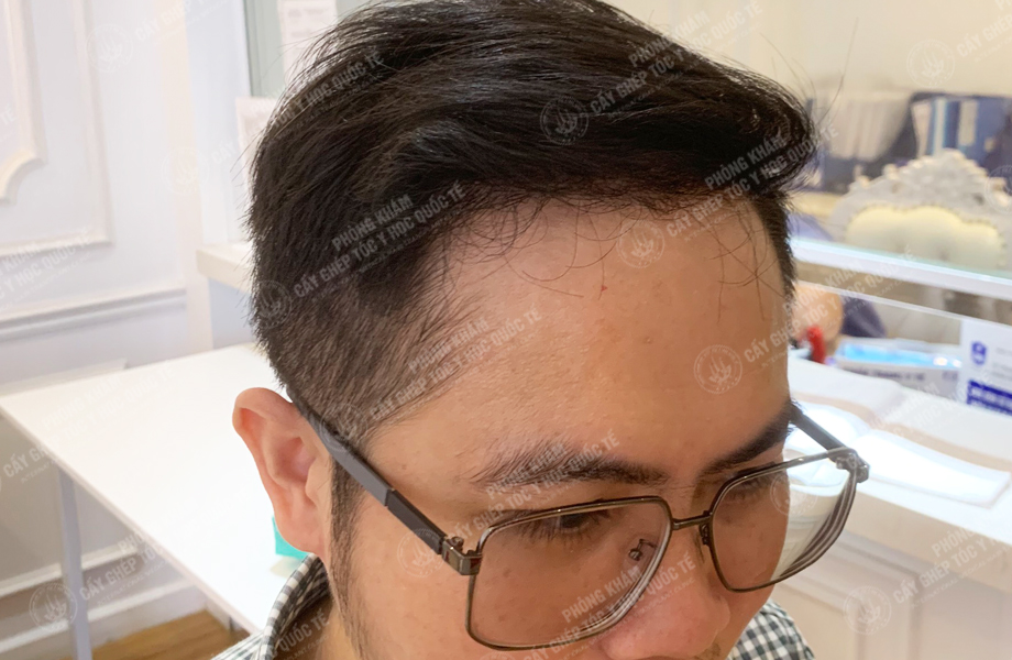 Bùi Văn Lanh - Cấy tóc đường chữ M 6