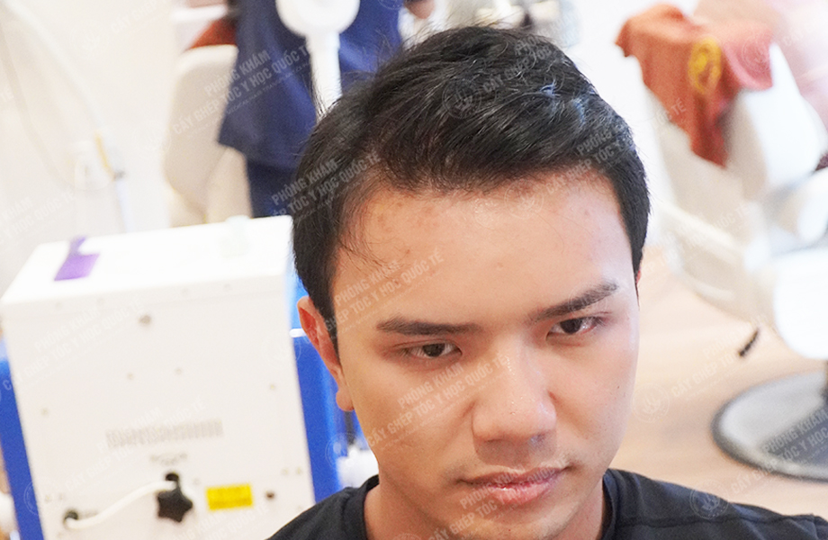 Nguyễn Quốc Hưng - Cấy tóc đường chữ M 6