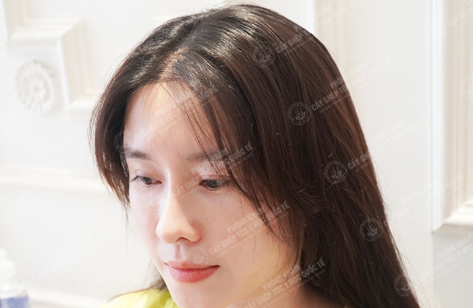 Nguyễn Ngọc Ngà - Cấy tóc tự thân 6