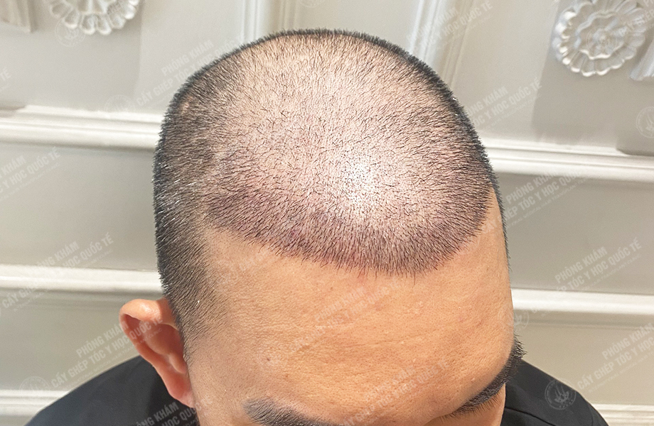 Đỗ Văn  Nhân - Cấy tóc đường chữ M 6