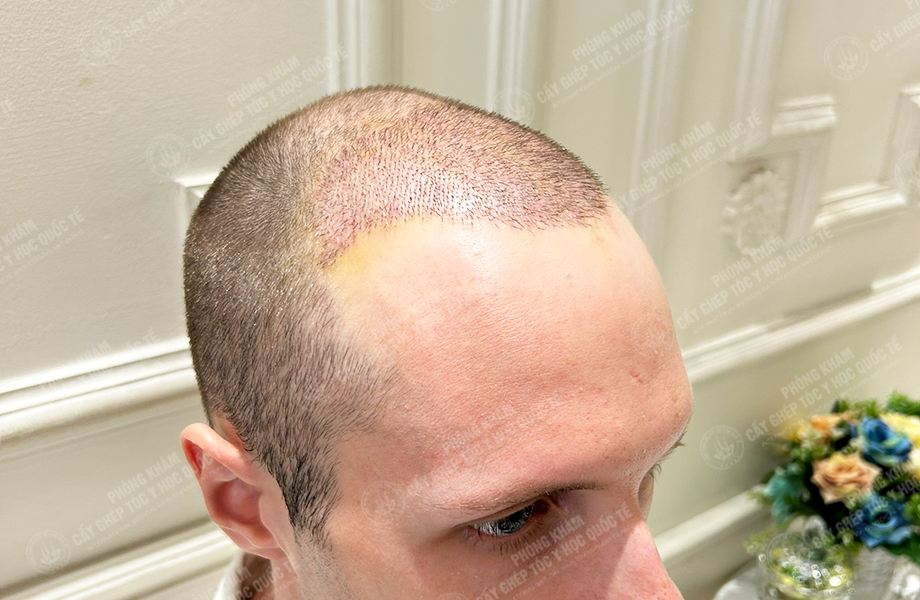 SONNY - Cấy tóc đường chữ M 6