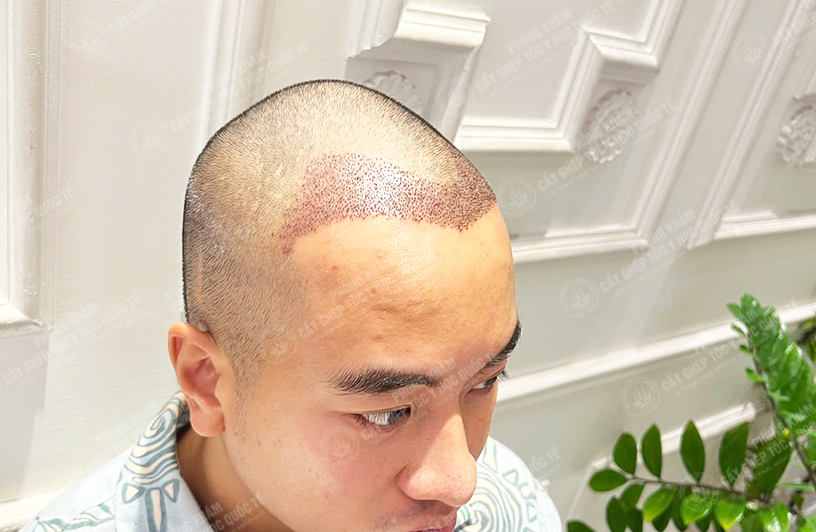 Nguyễn Nhật Hoàng - Cấy tóc đường chữ M 6