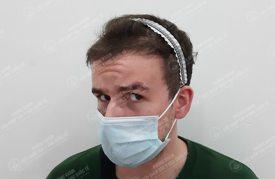 Leo Parry - Cấy tóc đường chữ M 6