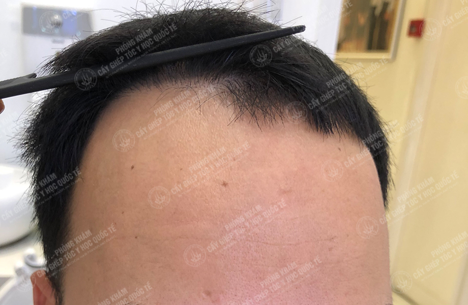 Hoàng Thái Sơn - Cấy tóc đường chữ M 6